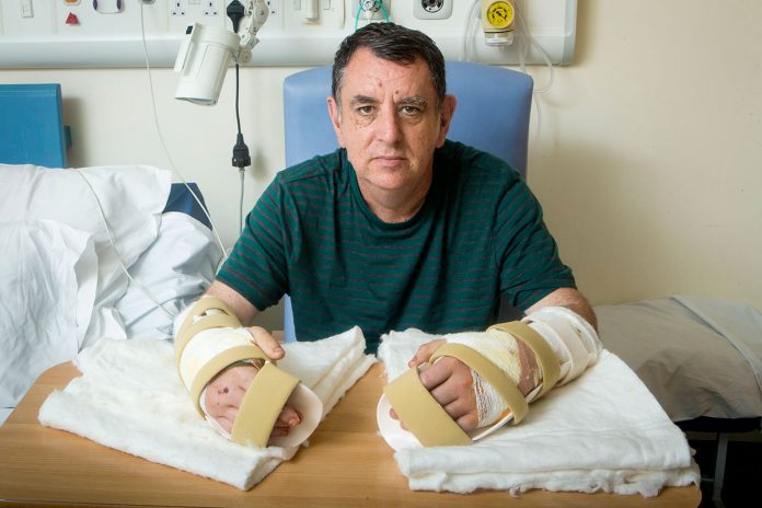 трансплантация на ръце