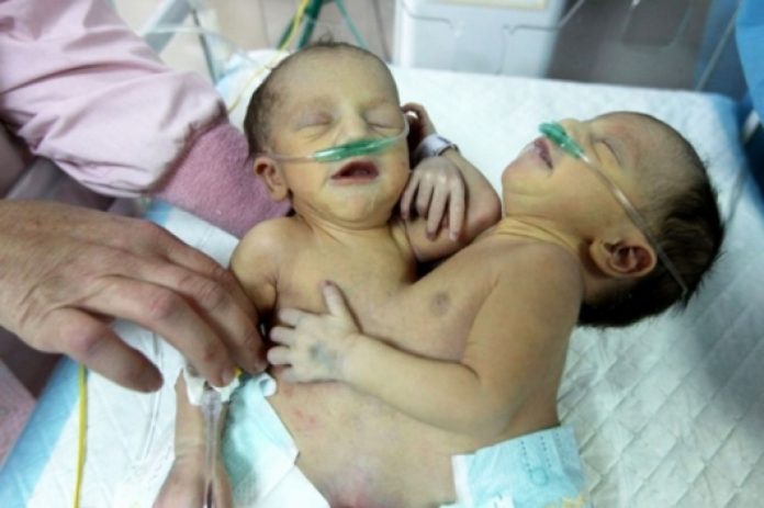 сиамски близнаци