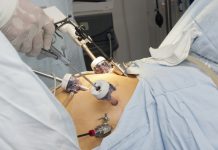 операции за отслабване