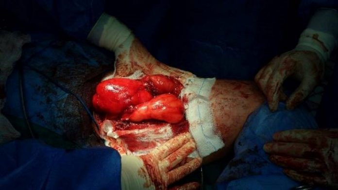 ампутация ампутация