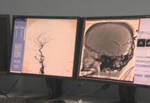 мозъчна операция