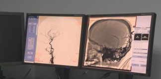 мозъчна операция