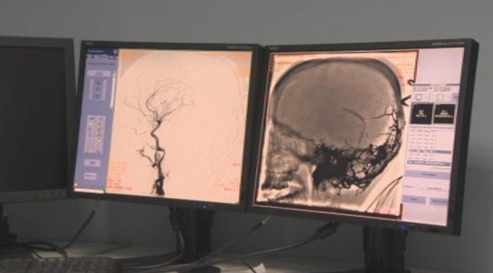 мозъчна операция