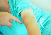 лаймска болест