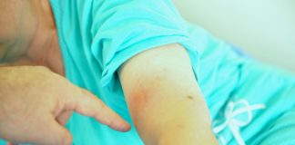 лаймска болест