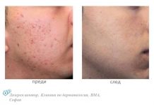 Безплатни прегледи за акне във ВМА и „Александровска“ акне