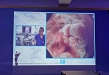 Махат полип от хранопровода за минути, вместо за 6 часа гастроентерология