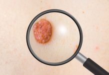 рак на кожата