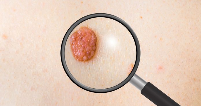 рак на кожата