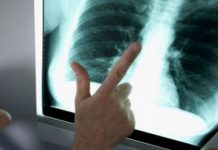 белодробна емболия