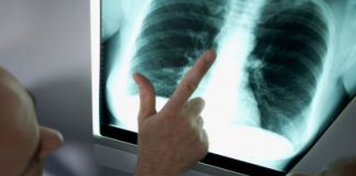 белодробна емболия