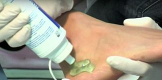 Остеопороза