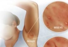 гноен хидраденит