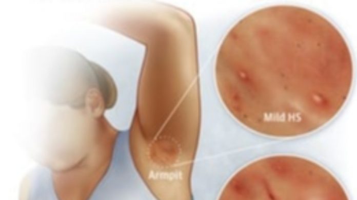 гноен хидраденит