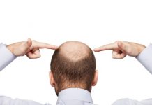 мъжката плешивост